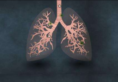 谣言:肺结节就是肺癌 