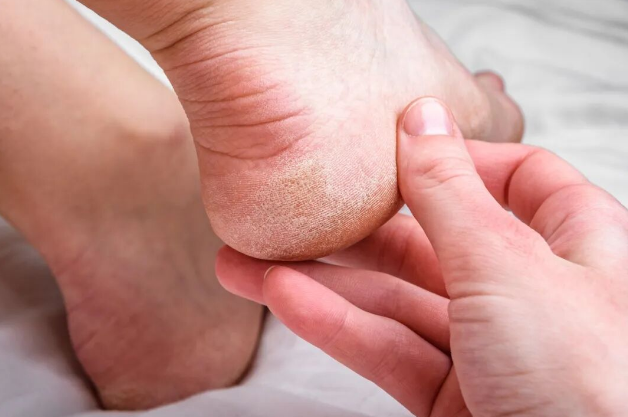 脚后跟开裂是缺乏维生素或者胶原蛋白？ 